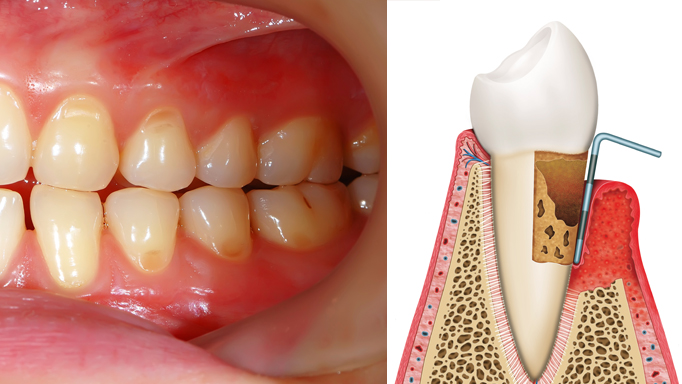 gingivitis