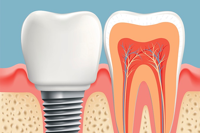Implantes Dentales: Cuando Son Necesarios